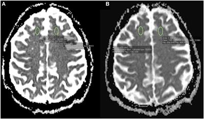 Acute Frontal Lobe Dysfunction Following Prefrontal Low-Frequency Repetitive Transcranial Magnetic Stimulation in a Patient with Treatment-Resistant Depression